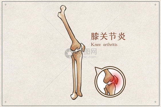 膝关节炎示意图图片