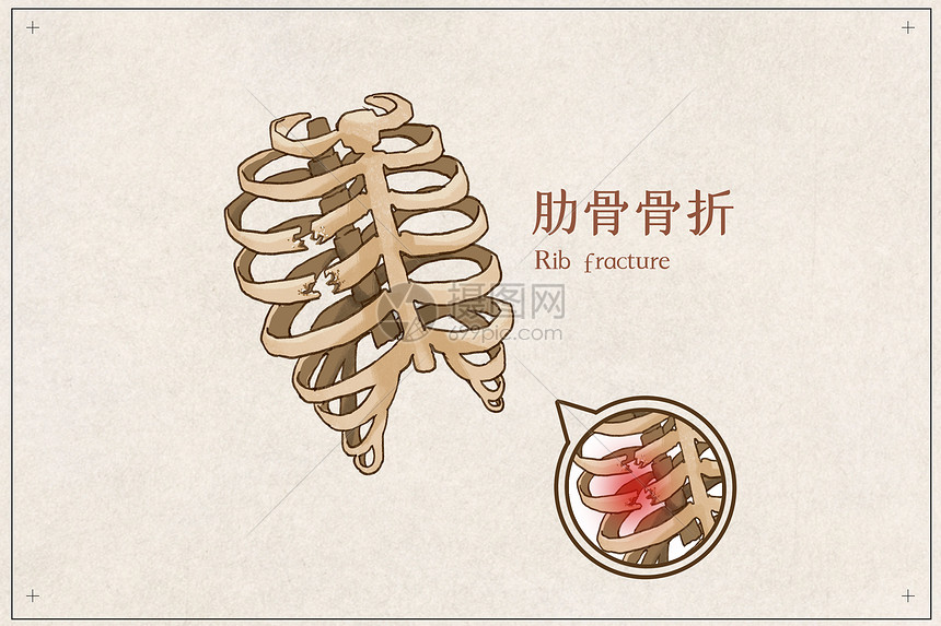 肋骨骨折示意图