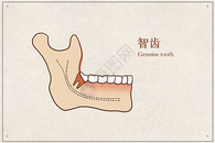 阻生智齿医疗插画示意图图片