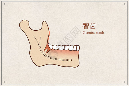 阻生智齿医疗插画示意图图片