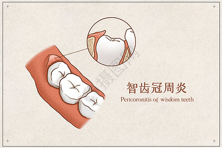 智齿冠周炎医疗插画示意图背景图片