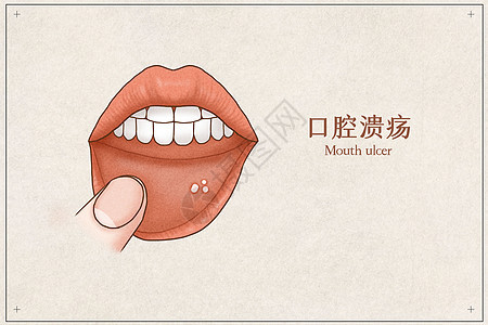 口腔溃疡医疗插画示意图图片