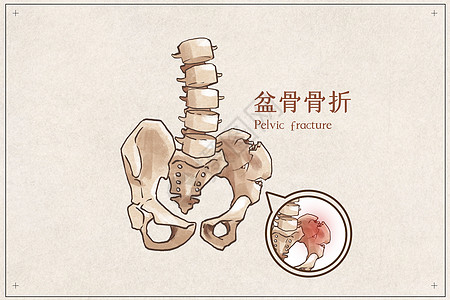 盆骨骨折示意图背景图片