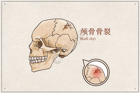 颅骨骨裂示意图高清图片