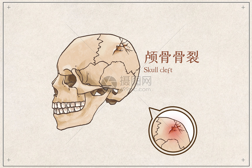 颅骨骨裂示意图图片