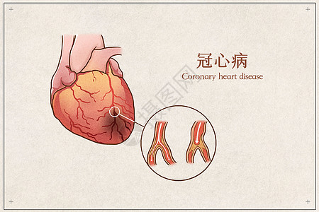 心脏解剖冠心病医疗插画示意图插画