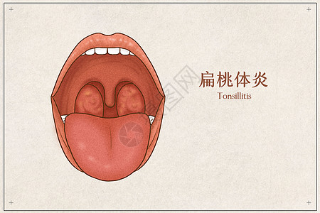 扁桃体炎医疗插画高清图片