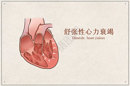 舒张性心力衰竭医疗插画示意图图片