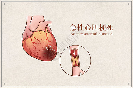 心脏解剖急性心肌梗死医疗插画示意图插画