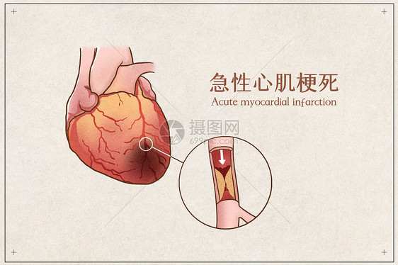 急性心肌梗死医疗插画示意图图片