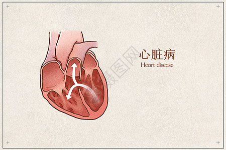 心脏病医疗插画示意图高清图片