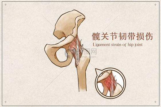 髋关节韧带损伤示意图图片