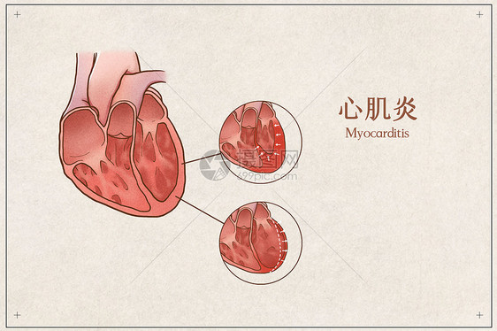 心肌炎医疗插画示意图图片