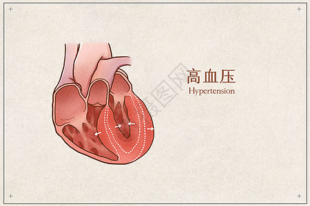 心脏解剖高血压医疗插画示意图插画