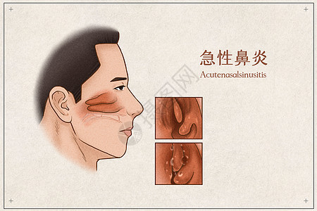 急性鼻炎医疗插画示意图图片
