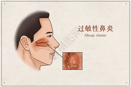 过敏性鼻炎医疗插画示意图高清图片