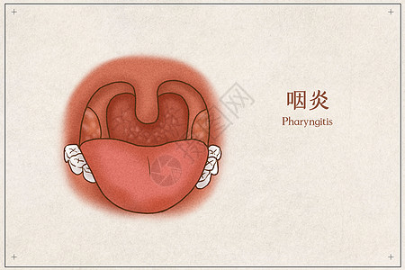 喉咙咽炎医疗插画示意图插画