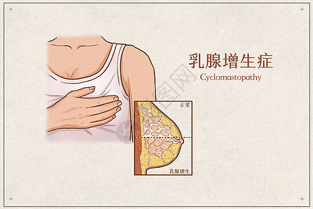 女性疾病乳腺增生症医疗插画示意图插画