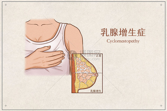 乳腺增生症医疗插画示意图图片