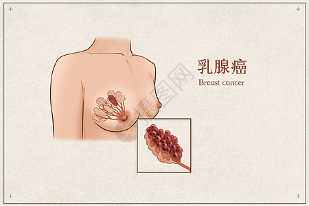 乳腺癌医疗插画示意图背景图片