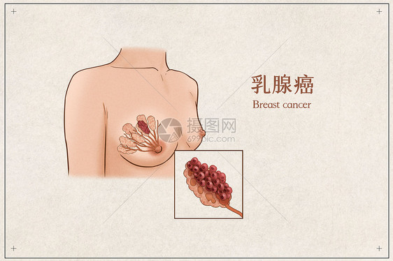 乳腺癌医疗插画示意图图片