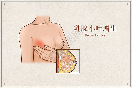 乳腺小叶增生医疗插画示意图背景图片