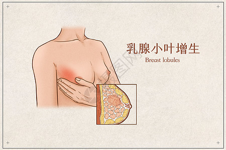 乳腺小叶增生医疗插画示意图图片