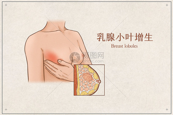 乳腺小叶增生医疗插画示意图图片