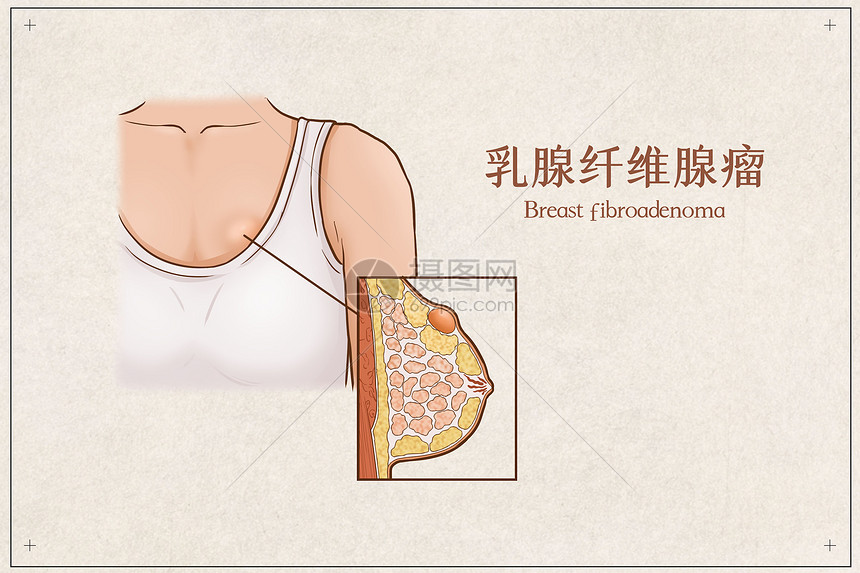 乳腺纤维腺瘤医疗插画示意图图片