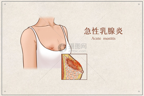 急性乳腺炎医疗插画示意图图片