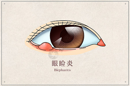 眼睑炎医疗插画背景图片