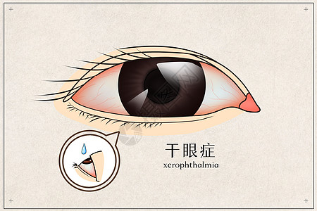 人体模型干眼症医疗插画插画