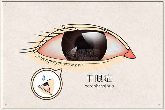 干眼症医疗插画图片