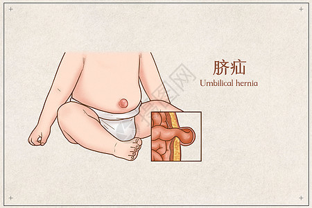 脐疝医疗插画图片