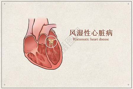 风湿性心脏病医疗插画图片