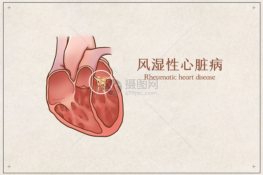 风湿性心脏病能活多久