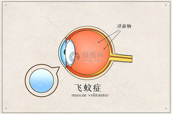 飞蚊症医疗插画图片