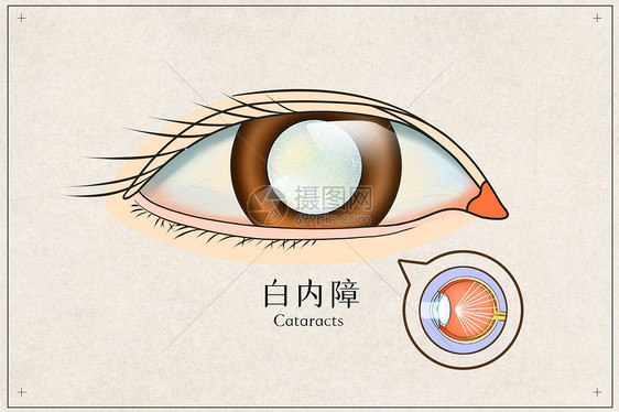 白内障医疗插画图片