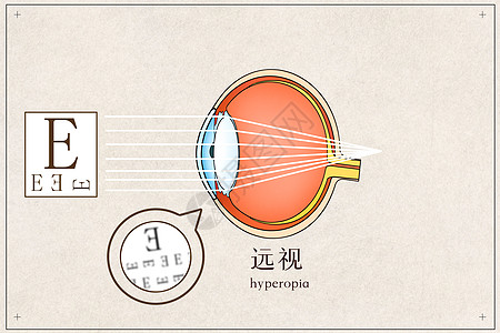 远视医疗插画图片