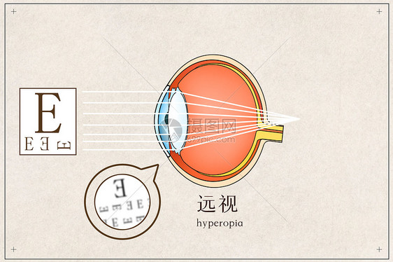 远视医疗插画图片