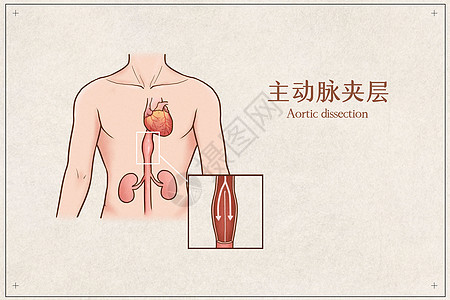 主动脉夹层医疗插画图片