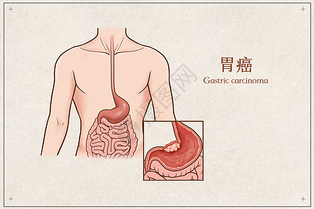 人体结构胃癌医疗插画插画