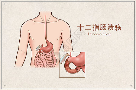 十二指肠溃疡医疗插画图片