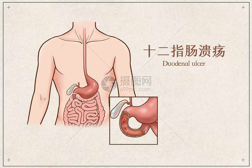 十二指肠溃疡医疗插画图片