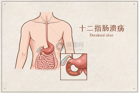 十二指肠溃疡医疗插画图片