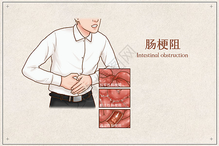 肠梗阻医疗插画图片