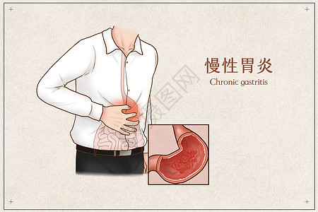 慢性胃炎医疗插画图片