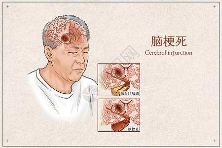 脑梗死医疗插画高清图片