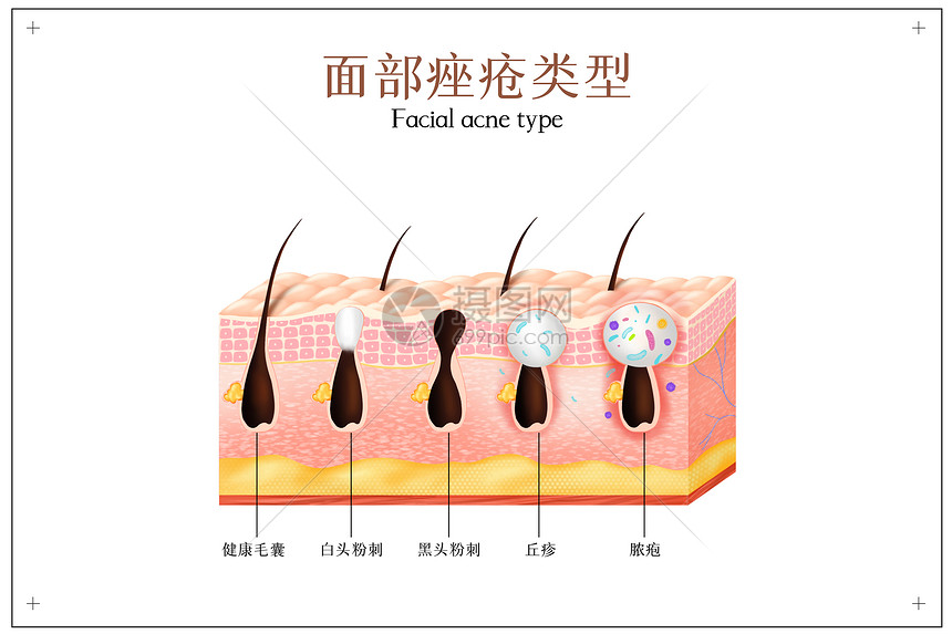 面部痤疮类型图片