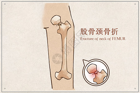 股骨颈骨折病例医疗插画图片